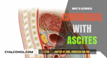 Understanding Alcoholic Cirrhosis with Ascites: Causes, Symptoms, and Treatment
