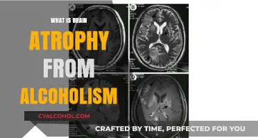 Understanding Brain Atrophy: The Impact of Alcoholism on Cognitive Health