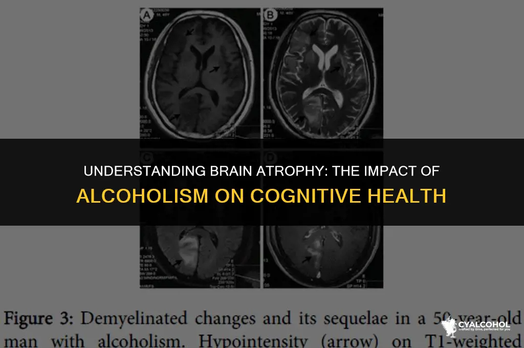what is brain atrophy from alcoholism