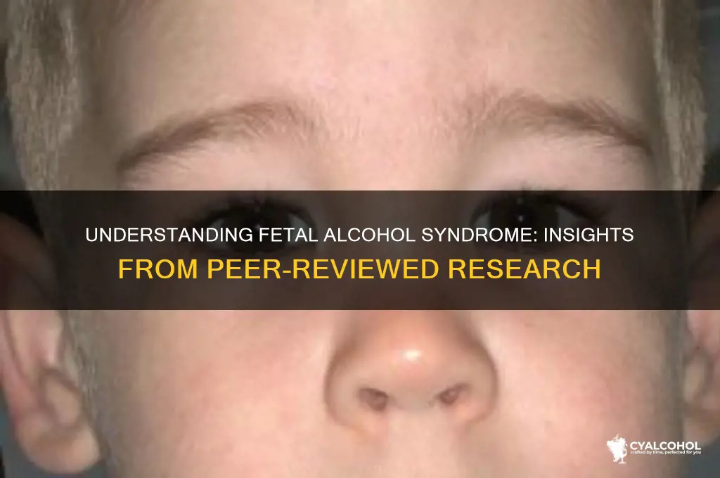 what is fetal alcohol syndrome peer reviewed articles