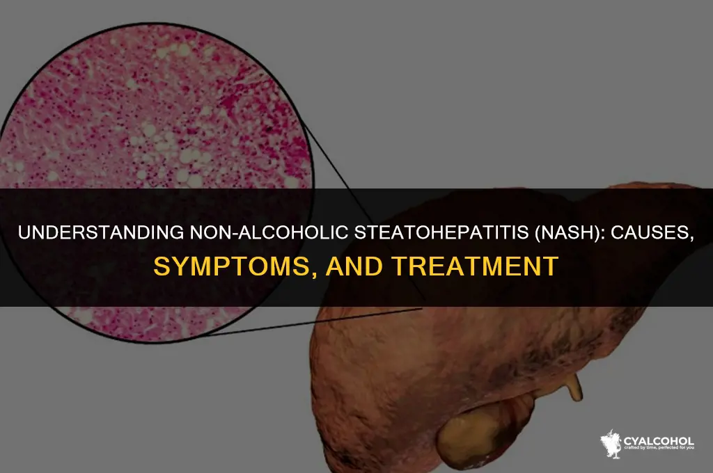 what is non alcoholic steatohepatitis nash
