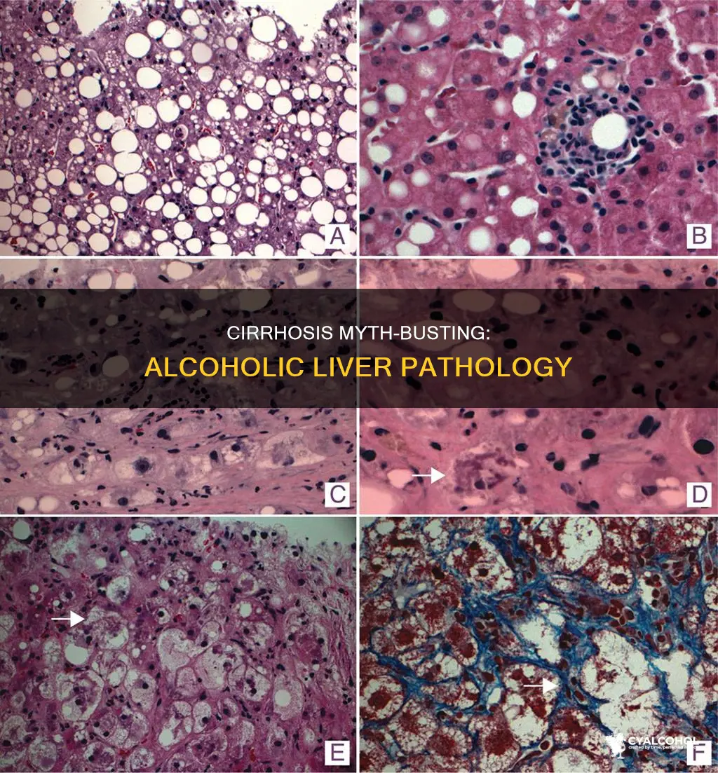 which statement is false about the pathophysiology of alcoholic cirrhosis